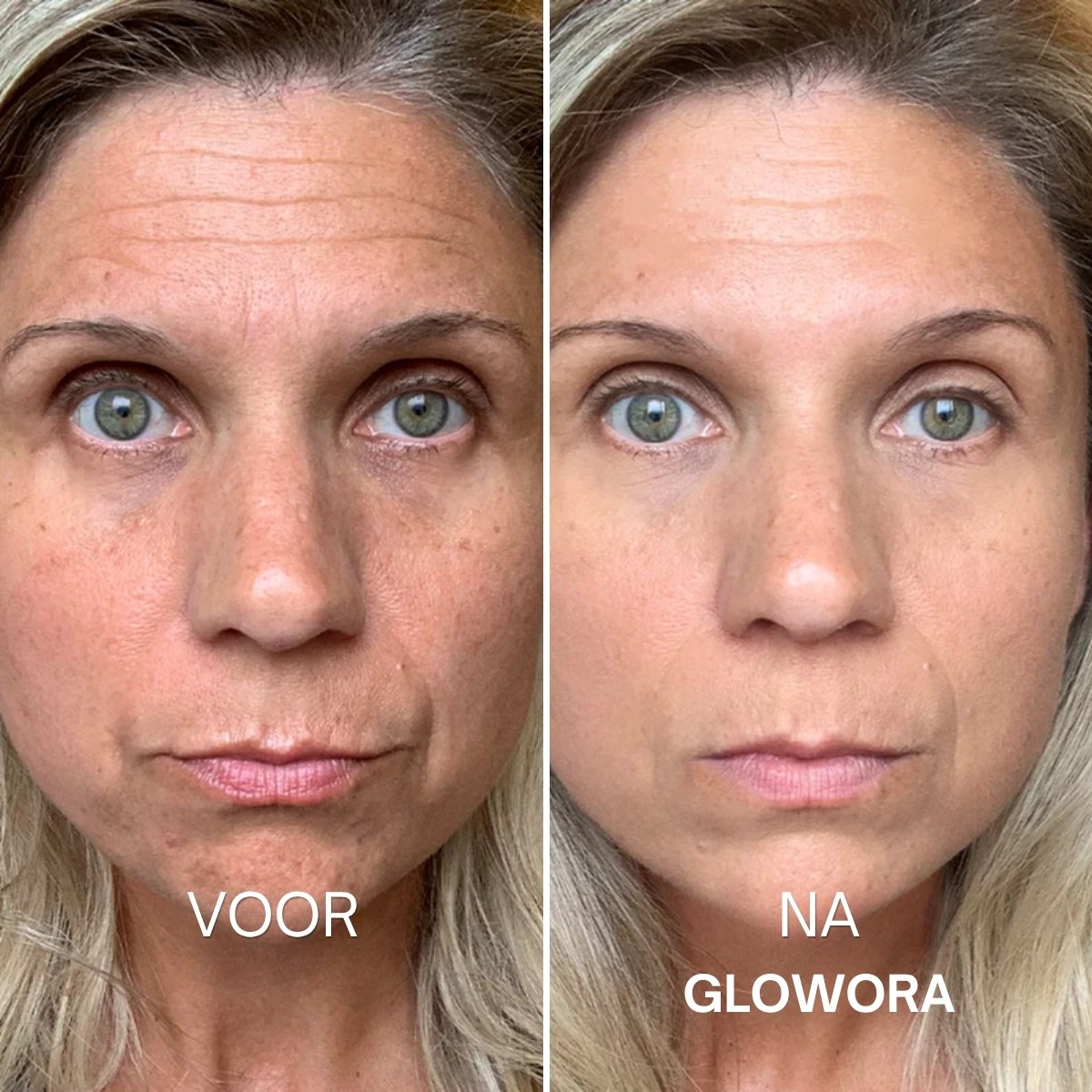 Voor en na Glowora