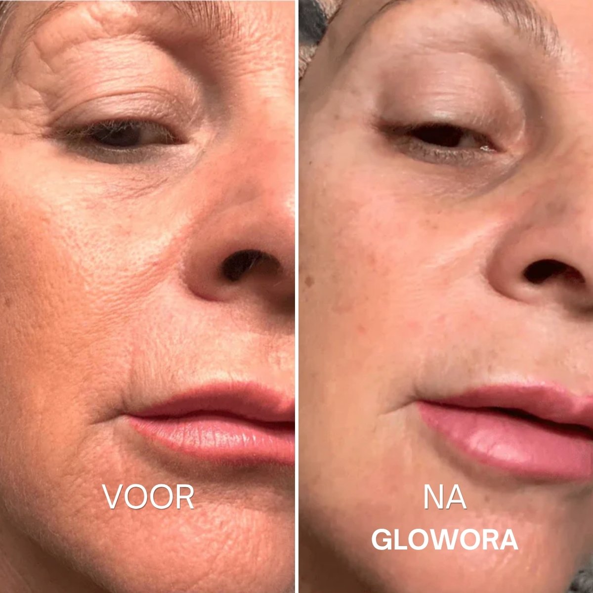 Voor en na Glowora