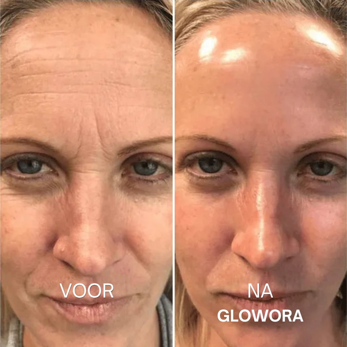 Voor en na Glowora
