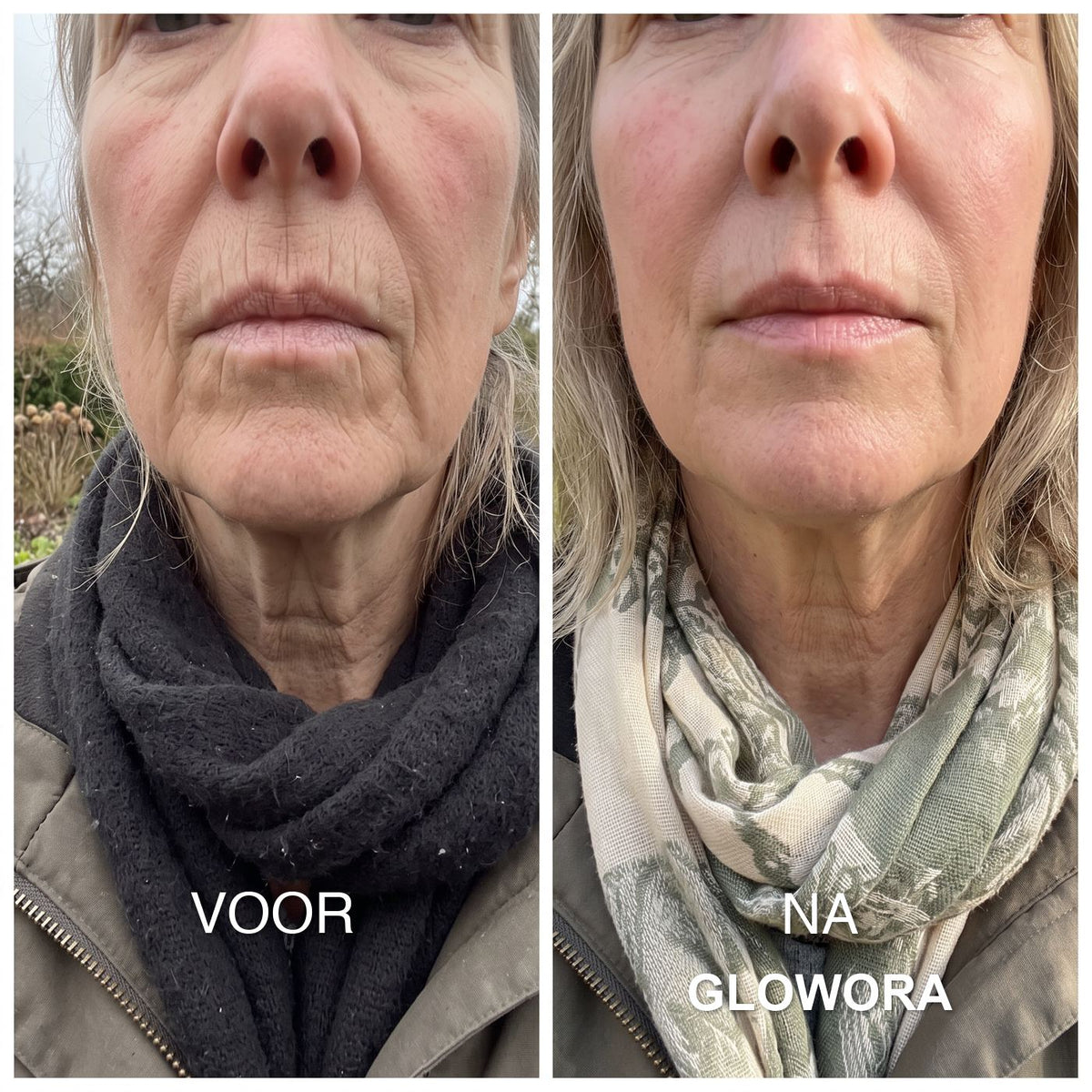 Klant voor en na, lijntjes boven de lip